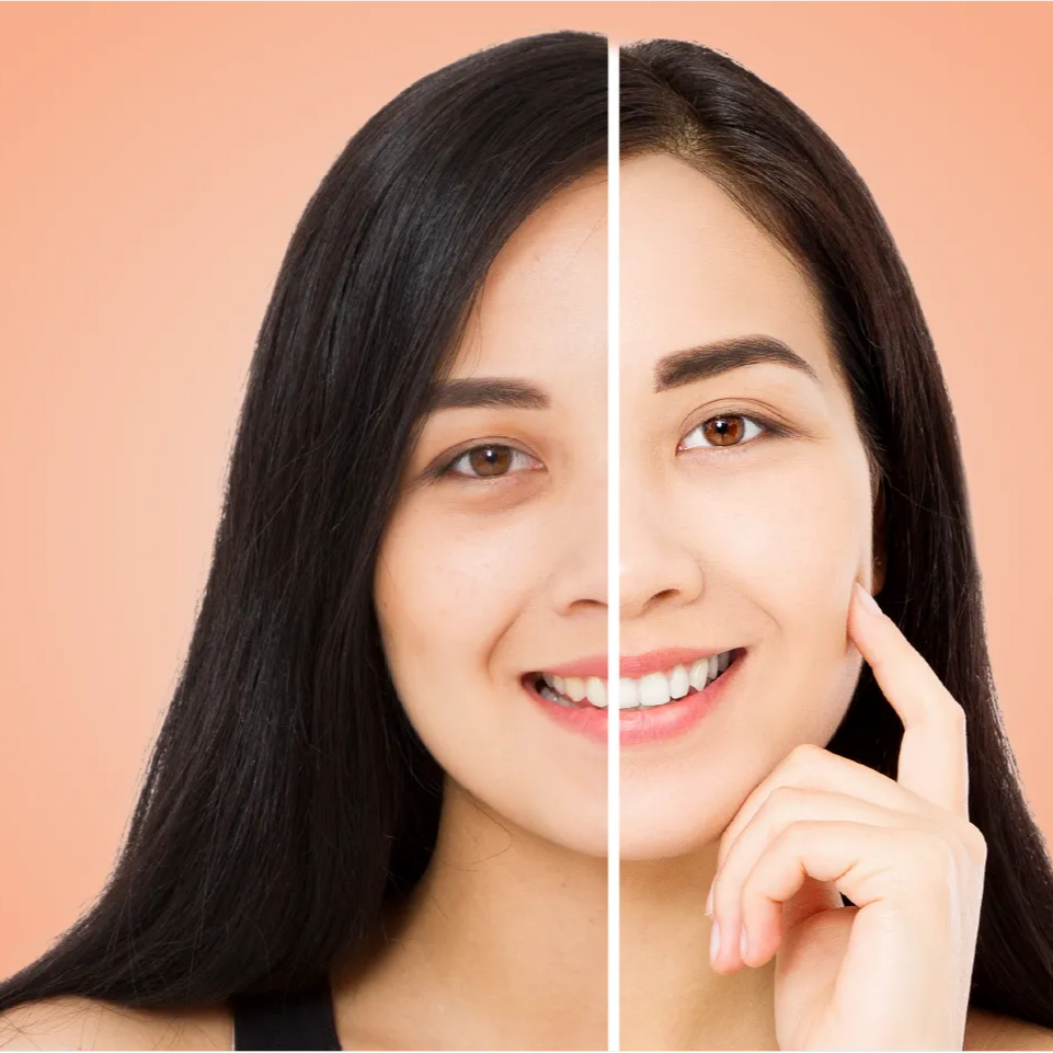 Permanent Dark Circle Removal