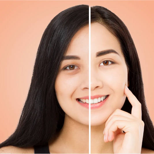 Permanent Dark Circle Removal